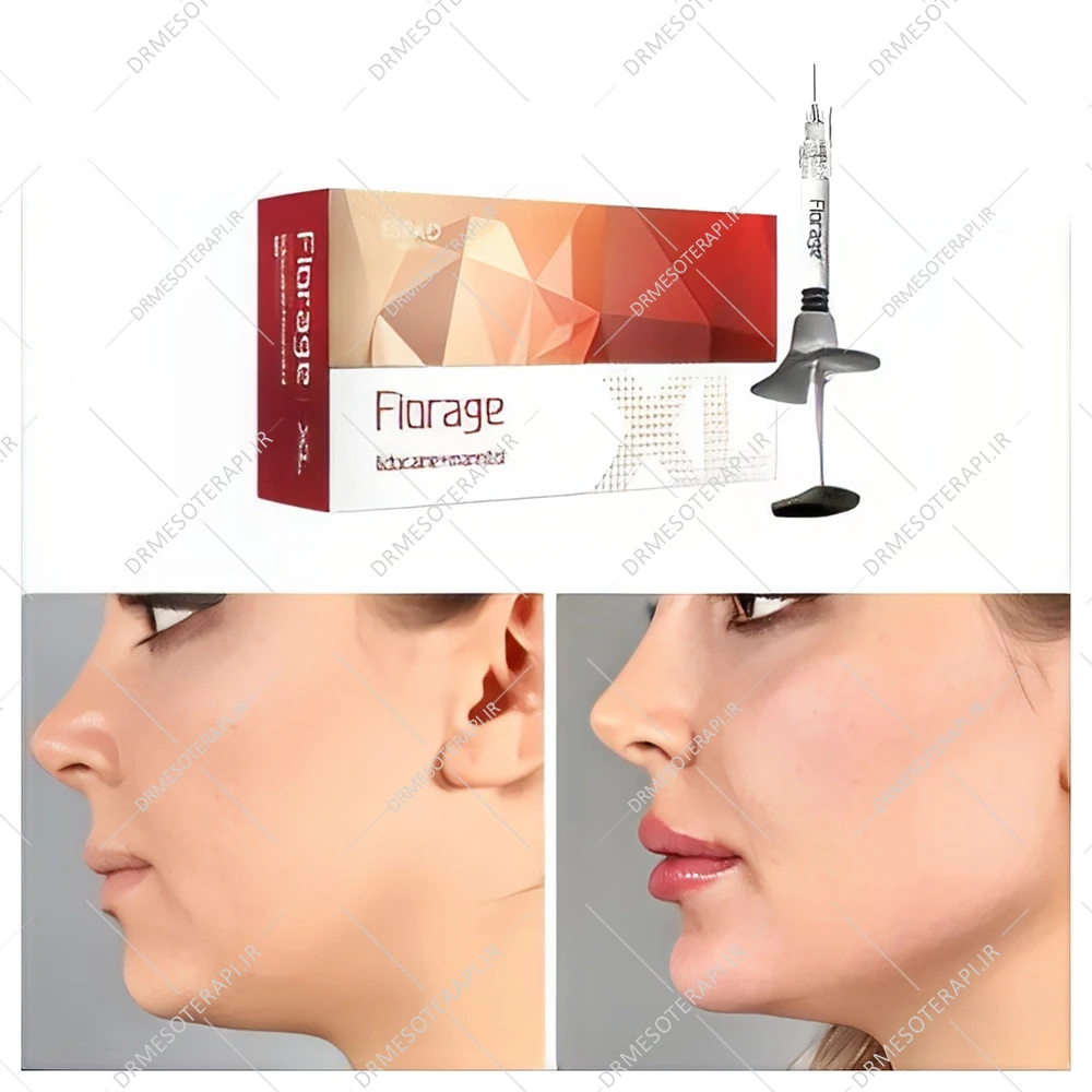 ژل فیلر فیورج ایکس ال XL